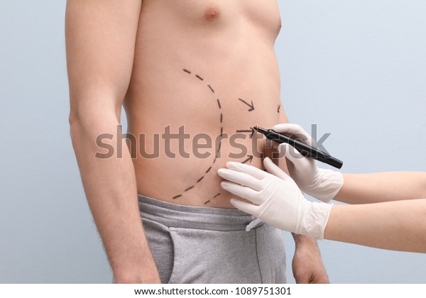 Doctor drawing lines on man\'s stomach with\
marker against light\
background