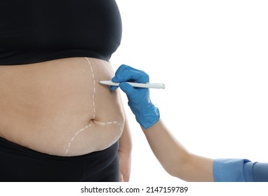 Doctor Drawing Marks On Obese Woman's Body Against White Background, Closeup. Weight Loss Surgery