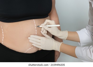 Doctor Drawing Marks On Obese Woman's Body Against Light Background, Closeup. Weight Loss Surgery