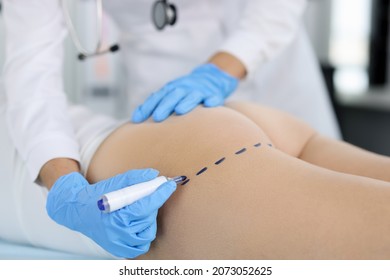 Doctor draws marks on the patient's buttocks with marker for body shaping