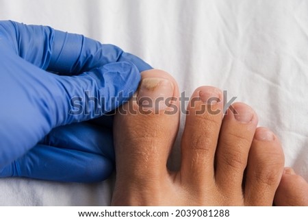A doctor examines bare foot with onycholysis on a toenail after damaging with tight shoes or using gel-lacquer