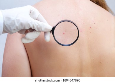 doctor examines the growths on the skin of an adult with a magnifying glass, diagnosis of skin cancer. Hemangioma, angioma, papilloma, mole