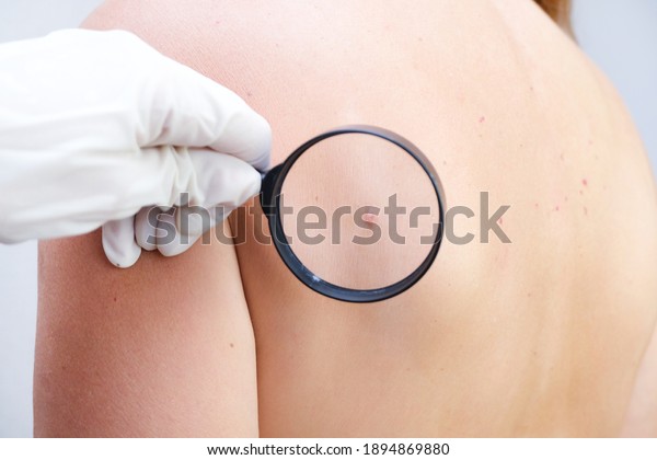 doctor examines the growths on the skin of an adult\
with a magnifying glass, diagnosis of skin cancer. Hemangioma,\
angioma, papilloma, mole