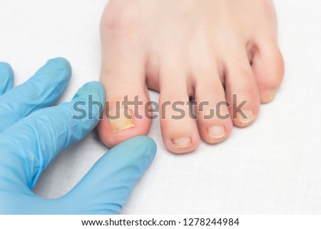 Doctor examines ingrown nail on female leg, onychocryptosis, close-up, white background, medical, disease