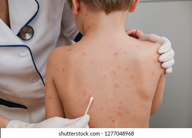 Doctor Examines Kids Skin Covered Blisters, Scar And Rash Caused By Chicken Pox. 	Varicella