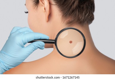 The doctor examines a large mole on the shoulder with a magnifying glass in the clinic. Cosmetology treatment of problem skin on the face and body.