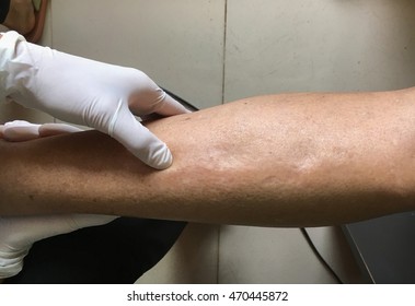 Doctor Examines Leg Of Heavy Patient With Edema