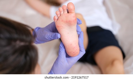 Doctor Examines Red Rashes On Feet Of Child Closeup