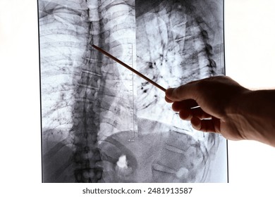 The doctor examines the X-ray of the damaged spine. Treatment and prevention of diseases of the spine, scoliosis, syphosis. - Powered by Shutterstock