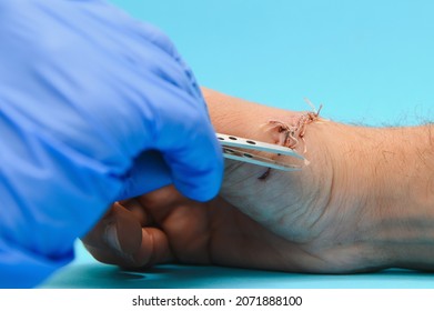 Doctor Examining Nerve Conduction On Palm Of Hand After Carpal Tunnel Syndrome