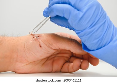 Doctor Examining Nerve Conduction On Palm Of Hand After Carpal Tunnel Syndrome