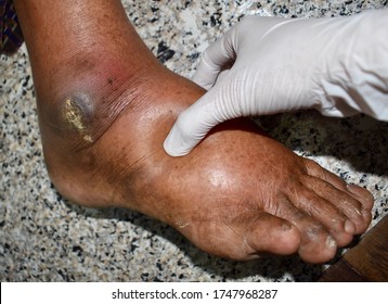 Doctor Examining Swollen Foot Pitting Oedema Foto Stok 1747968287