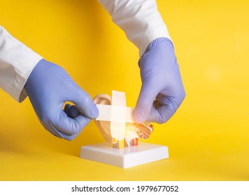 Doctor Glues A Plaster On A Mock-up Of A Human Ear On A Yellow Background. Hearing Treatment And Recovery Concept After Covid 19, Chronic