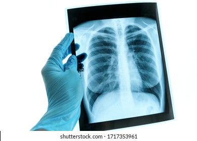 Doctor Hands Holding Patient Chest X-ray Film Before Treatment.Covid-19 Scan Body Xray Test Detection For Covid Virus Epidemic Spread Concept.