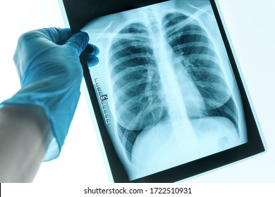 Doctor Hands Holding Patient Chest X-ray Film Before Treatment.Covid-19 Scan Body Xray Test Detection For Covid Virus Epidemic Spread Concept.