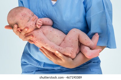 Doctor Holding A Beautiful Newborn Baby Which Is Sick Rubella Or Measles