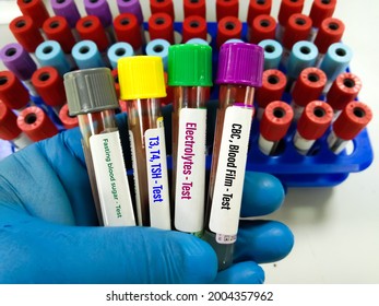 Doctor Holding Blood Sample Tubes For CBC, Blood Film, Electrolytes , T3, T4, TSH And Fasting Blood Suger Test At Medical Laboratory.