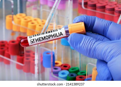 Doctor Holding Blood Tube Positive Analysis To Haemophilia. Blood Sample With Positive Diagnosis Of Hemophilia