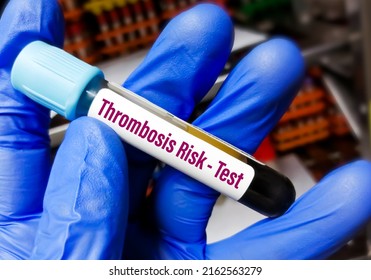 Doctor Holding Blood Tube For Thrombosis Risk Factor Test. Bleeding Disorder.