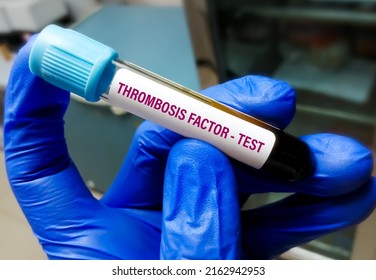 Doctor Holding Blood Tube For Thrombosis Risk Factor Test. Bleeding Disorder.