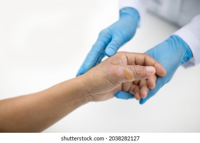 Doctor Holding Patient's Hand And Thumb With Burn Injuries. Nurse With Gloves Attending A Man's Blisters.Wound Care In Hospital.White Background.Medical Officer Treating Patient With Serious Burns.