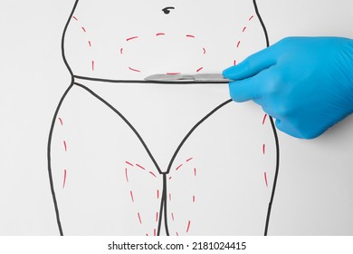 Doctor Holding Scalpel Near Drawn Human Body With Marks On White Background, Top View. Weight Loss Surgery