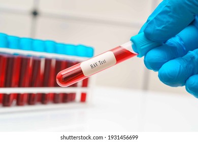 doctor holding a   test tube blood sample, with Hepatitis A virus.
