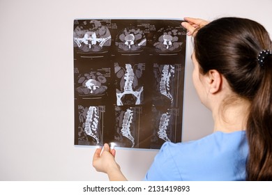 The Doctor Holds A CT Scan Of The Spine Of A Patient With Scoliosis And Protrusion Of The Intervertebral Discs