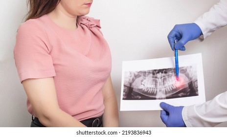 The doctor holds a panoramic X-ray picture of the patient's teeth with a sick semi-urethinal wisdom tooth. Wisdom teeth extraction concept in dentistry, dental abscess - Shutterstock ID 2193836943