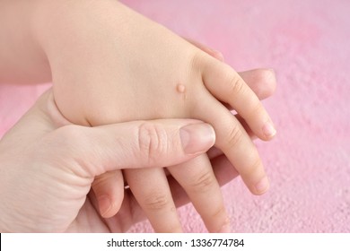 The doctor holds a small hand of a child affected with warts with selective focus on blurred pink background. Papillomavirus in a child's hand and fingers. Pediatric dermatology. Skin diseases