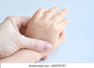 warts on hands small medicamente la copii