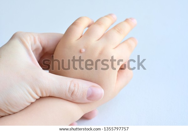 Papillomas hand Papillomas hand, Papillomas hand