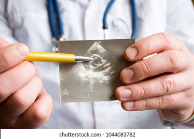 Doctor holds snapshot of ultrasound of heart and indicates with ballpoint pen on possible pathology of heart aortic valve. Concept photo of cardiac ultrasonic diagnostics of valve apparatus in adults 