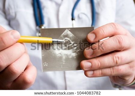 Doctor holds snapshot of ultrasound of heart and indicates with ballpoint pen on possible pathology of heart aortic valve. Concept photo of cardiac ultrasonic diagnostics of valve apparatus in adults 