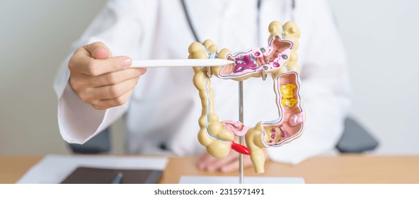 Doctor with human Colon anatomy model. Colonic disease, Large Intestine, Colorectal cancer, Ulcerative colitis, Diverticulitis, Irritable bowel syndrome, Digestive system and Health concept - Shutterstock ID 2315971491