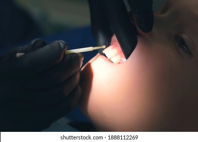 Doctor hygienist applying fluoride to teen teeth with cotton swab in dentistry. Covering using fluoride gel. Cure concept. Dentist making fluoridation child boy teeth after cleaning for protection.