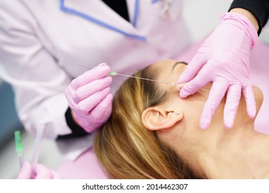 Médico inyectando hilos de tratamiento de sutura de DOP en la cara de una mujer.