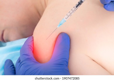 The Doctor Injects An Anti-inflammatory Drug Into The Shoulder Joint Where There Is Pain And Inflammation. Treatment Concept For Arthrosis And Bursitis, Joint Capsule