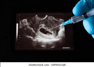 The doctor injects a shot into the uzi pregnancy, an abortion, a syringe, a glove, a black background