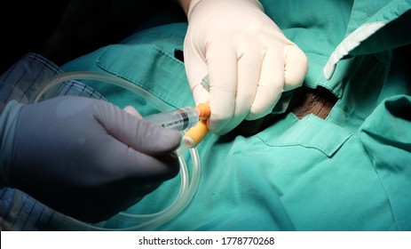 Doctor Inserting Urinary Vladder Catheter Before Surgery Ubder Aseptic Technique.