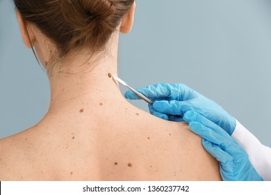Doctor with lancet going to remove mole from patient's skin