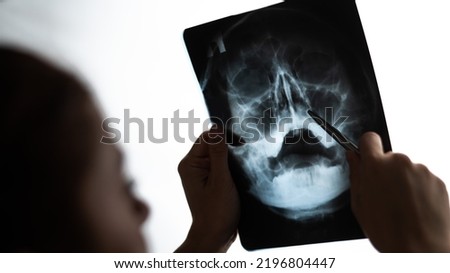 The doctor looks at the x-ray of the sinuses.