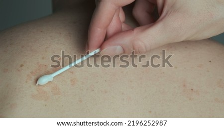Doctor lubricates the red spots on the back of the patient with an ointment with a cotton swab. Treatment of skin disease, pityriasis versicolor, close-up.