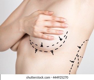 doctor makes dotted line on female body for cellulite correction. cosmetic surgery. lifting and breast augmentation