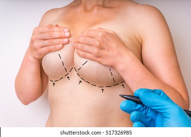 Doctor makes dotted lines on female body for cosmetic surgery or lifting and breast augmentation