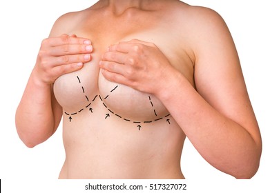 Doctor makes dotted lines on female body for cosmetic surgery or lifting and breast augmentation