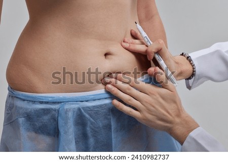 the doctor makes markings with a marker before the tummy tuck operation, Abdominoplasty
