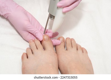 The doctor makes the procedure for the treatment of foot fungus. A patient receiving laser therapy for a toenail. Fungal infection on the nails. Treatment of onychomycosis with a medical laser
