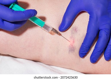Doctor makes sclerotherapy injection into patient's damaged veins, thrombosis and bruises. Varicose Veins Treatment, close-up