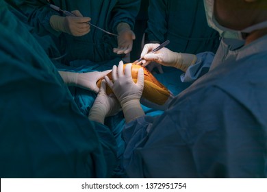 Doctor Making Incision On The Patient 's Knee In Case Of Total Knee Replacement Surgery Inside Operating Room With Dramatic Light From Surgical Lamp. Team Work Was Showing, Medical Concept.